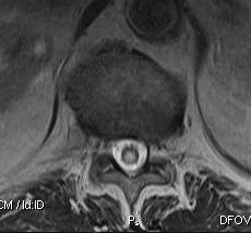 Syrinx Thoracic MRI Axial